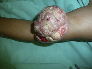 Pedunculated exophytic tumor with eroded and bleeding surface.