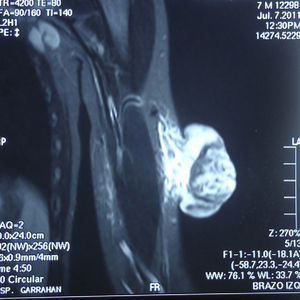 Nuclear magnetic resonance imaging: exophytic formation with a heterogeneous nodule surrounded by a hypointense halo and abundant vascularity in the stalk.