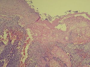 Histology: lobules of basaloid cells with maturation toward the surface and ghost cell formation (hematoxylin-eosin, original magnification ×100).
