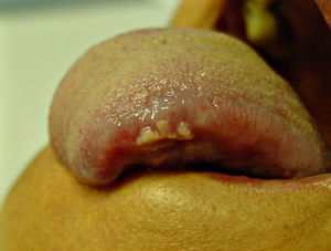 Case 5. Whitish papillary lesions on the lateral border of the tongue.