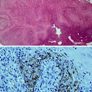 Biopsy of the lesion shown in Figure 1. Upper image: intense inflammatory infiltrate with a predominance of plasma cells (hematoxylin-eosin, original magnification × 50). Lower panel: IHC of the same biopsy (original magnification × 400) showing infiltration of treponemata, which appear as brownish bead-like structures.