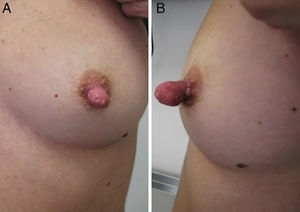 Skin lesion located on the patient