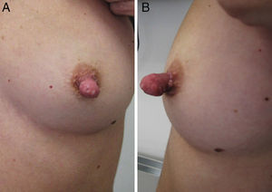 Skin lesion located on the patient's left nipple.