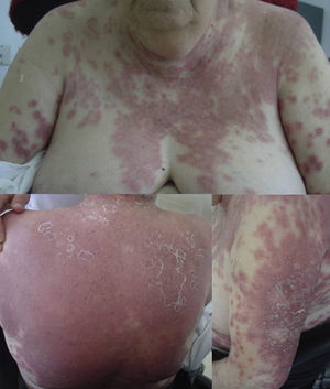 Erythematous, edematous plaques with multiple nonfollicular pustules.