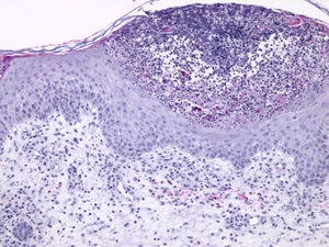 Subcorneal pustule and perivascular infiltrate of lymphocytes and eosinophils. Hematoxylin-eosin, original magnification ×40.