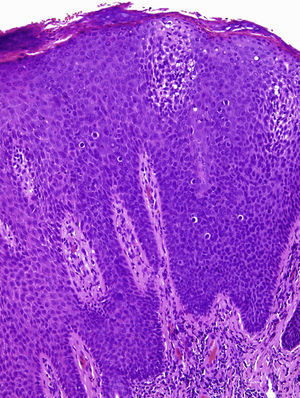 Hypoplastic epidermis with loss of normal cell architecture, moderate cellular atypia, dyskeratosis, and koilocytes (hematoxylin-eosin, original magnification ×40).