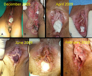 A, Multiple brownish flattened lesions on the vulva. B, Wound with granulation tissue 10 days after laser treatment. C, New whitish velvety plaques diagnosed as bowenoid papulosis (April 2009). D, Postoperative result following the second treatment session with carbon dioxide laser. E-G, Subsequent instances of recurrence, controlled with treatment.