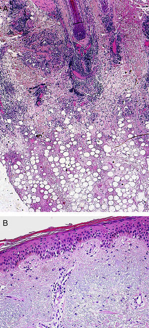 A, Predominantly lymphocytic infiltrate in the deep dermis and adipose tissue, with hyaline fat necrosis (hematoxylin-eosin, original magnification ×40). B, Vacuolar changes in the basal layer of the epidermis (hematoxylin-eosin, original magnification ×200).