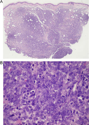 A, Diffuse dermal infiltrate separated from the epidermis by a normal collagen band (Grenz zone) and marked involvement of the hypodermis (hematoxylin-eosin, original magnification ×4). B, Higher magnification shows that the infiltrate is composed of a proliferation of centroblast-like and immunoblast-like neoplastic cells, together with several smaller cells with the characteristics of mature lymphocytes (hematoxylin-eosin, original magnification ×60).