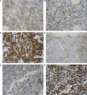 A, Neoplastic cells, which were the main component of the infiltrate, were positive for CD20 (IHC, original magnification ×40). B, Neoplastic cells were intensely positive for bcl-2 (IHC, original magnification ×40). C, Expression of bcl-6 in the neoplastic cells composing the infiltrate (IHC, original magnification ×40). D, Expression of MUM-1 (IHC, original magnification ×40). E, Small accompanying cells were positive for CD3 (IHC, original magnification ×4). F, Marked Ki-67 expression with an estimated proliferation index of 90% (IHC, original magnification ×40). IHC indicates immunohistochemistry.