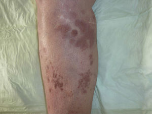 Erythematous-brownish macules that appear to be residual lesions 4 weeks after the first visit.