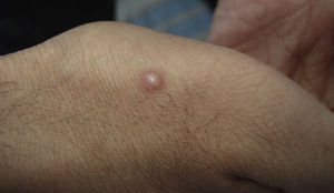 Nodular lesion 9mm in diameter in a patient with disseminated cryptococcosis and infected with human immunodeficiency virus/AIDS.