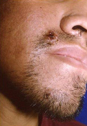 Ulcerated, crusted lesions caused by Cryptococcus neoformans in a hairy area in a patient with AIDS and multiorgan involvement.