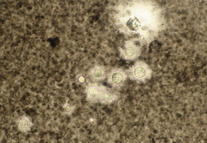 Cryptococcus neoformans. India ink staining reveals a thick capsule (original magnification, ×40).