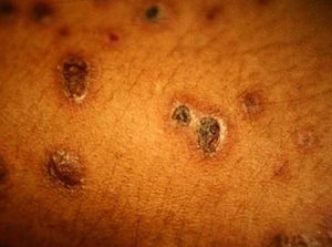 Crusted lesions and umbilicated lesions (different phases of development) caused by Histoplasma capsulatum in a patient with immune reconstitution inflammatory syndrome in different phases of development.