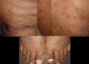 Disseminated violaceous nonpruritic maculopapular lesions in a patient with disseminated histoplasmosis.