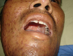 Disseminated histoplasmosis with characteristic small ulcers on the palate.