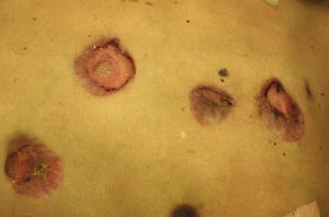 Pustules, plaques, and ulcerative nodules with erythematous-violaceous coloration, surrounded by a pigmented halo, characteristic of disseminated coccidioidomycosis.