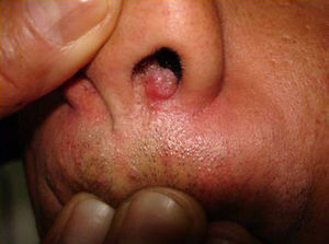 Isolated ulcerated nodule: cutaneous coccidioidomycosis arising from pulmonary dissemination.