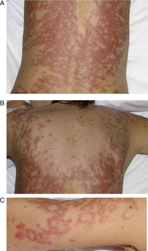 A 54-year-old woman with a history of epilepsy and subacute lupus erythematosus after treatment with oxcarbazepine started 2 months earlier. A, B, and C, Scaly, erythematous annular lesions on the lumbar region of the back, shoulder, and arms, respectively. Symptoms resolved 3 months after the antiepileptic drug was discontinued.