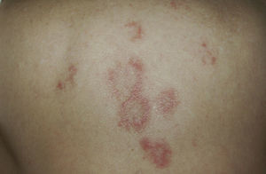 A 79-year-old woman with a history of metastatic ovarian cancer. The back lesions are clinically and histopathologically compatible with subacute lupus erythematosus of 2 months’ duration. The patient reported having taken bisoprolol in recent months, and the lesions resolved after the drug was stopped.