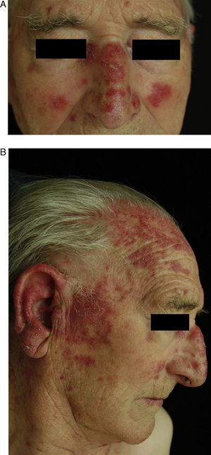 A and B, An 82-year-old man with scaly, erythematous lesions on the face and arms that appeared 9 months earlier. Histopathology was compatible with chronic discoid lupus. The patient had been treated with hydrochlorothiazide. The lesions resolved several months after treatment was discontinued.