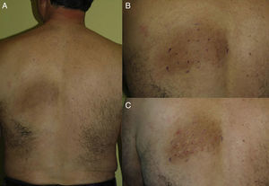 Case 1. A, Prior to treatment. B, Injection point marks. C, Immediately after treatment. Visible edema at injection sites.