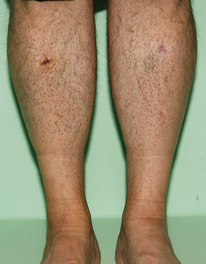 Reddish papules distributed symmetrically on the legs.