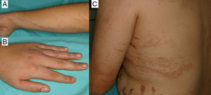 A, Linear lichenoid eruption following the Blaschko lines on the left upper limb. B, Linear lichenoid eruption on the first, third, fourth, and fifth fingers of the left hand. C, S-shaped linear lichenoid eruption on the left hemithorax.