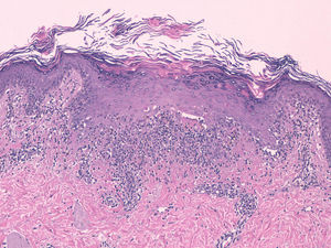 Lichenoid dermatitis: orthokeratotic hyperkeratosis with a scaly appearance, focal hypergranulosis, slight irregular epidermal hyperplasia, blurring of the dermal-epidermal junction, basal layer vacuolization, and necrotic keratinocytes (hematoxylin-eosin, original magnification × 200).