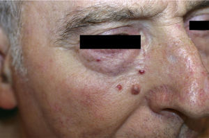 Two erythematous plaques in the right paranasal-infrapalpebral region (image taken after excision of 1 of the lesions).