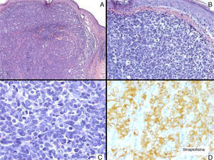 A, Tumor consisting of nests of polygonal cells (hematoxylin-eosin [H-E], original magnification ×5). B, These cells were irregular and atypical and there was no epidermal involvement (H-E, original magnification ×20). C, Abundant mitotic figures are apparent (H-E, original magnification ×40). D, These cells were positive for synaptophysin (H-E, original magnification ×40).
