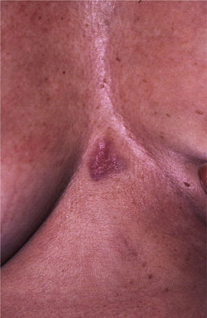 Sternal erythematous-violaceous plaque.