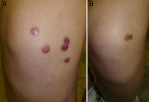 Rounded, violaceous papular lesions on the knees of the patient. A, Right knee. B, Left knee.