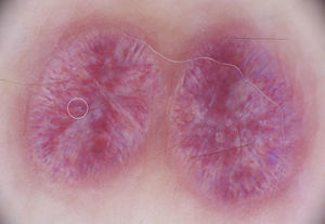 Image of the lesions obtained with a polarized light dermatoscope attached to a Canon Powershot A160 camera using the DermLite Foto attachment (3Gen LLC). Rosettes (indicated by a white circle in the lesion on the left; a larger number of rosettes are seen in the central area of the lesion on the right) are in evidence, along with irregularly shaped vessels and a clear rainbow pattern.