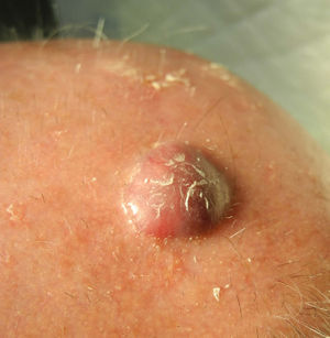 Tumor on the scalp and nearby actinic keratoses.