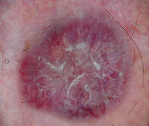 Dermoscopic image, obtained using a polarized light contact dermoscope, showing irregular blood vessels in the peripheral area and a rainbow pattern in the center.