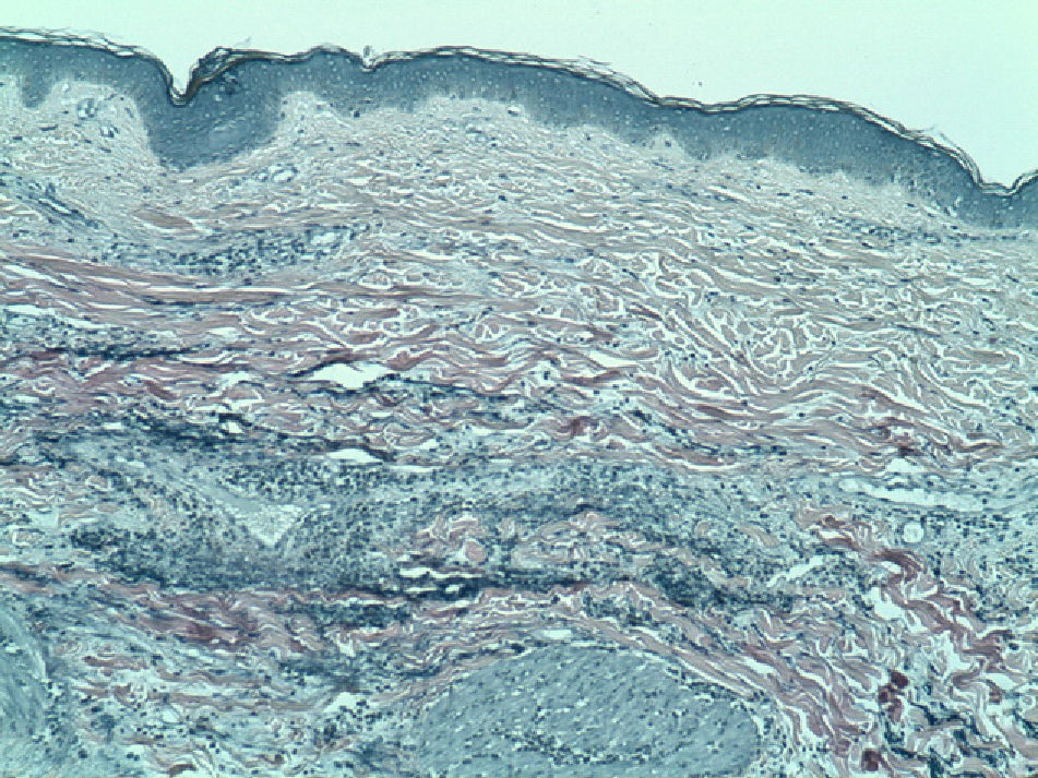 Anetoderma Face Primary Anetoderma Associated With Primary Sjögren Syndrome and ...