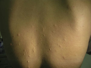 Skin-colored papules with a wrinkled surface on the upper third of the back, suggestive of anetoderma.