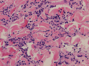 Acute inflammatory interstitial infiltrate with abundant neutrophils in the reticular dermis (hematoxylin-eosin, original magnification ×200).