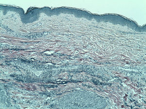 Histopathology showing loss and fragmentation of elastic fibers in the papillary and reticular dermis (Verhoeff-van Gieson stain, original magnification ×100).