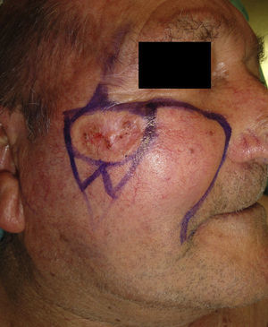 Morpheaform basal cell carcinoma over the right zygomatic arch, with a largest diameter of 2.5cm. Design of the original plasty: a rotation flap with an inferior M-plasty and a superolateral triangle to reduce tension.