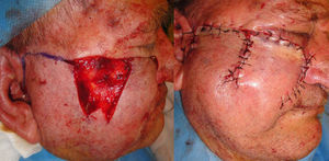 Design of the preauricular rotation flap with its base oriented anteriorly. Suture with interrupted 4-0 silk sutures. Mild edema and a small hematoma in the immediate postoperative period.