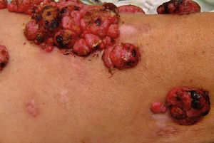Melanoma-associated Leukoderma. Multiple pink macules are observed, in addition to hypochromic plaques, some with a cicatricial appearance, adjacent to tumors of an angiomatous appearance (melanoma metastasis) on the anterior face of the left thigh. This patient has been reported previously by Salas-Alanís et al.17