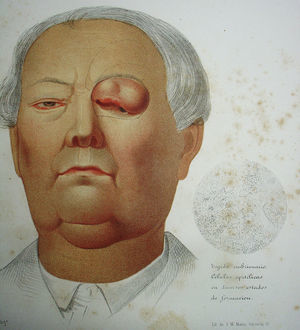 Color lithograph from José Eugenio de Olavide's atlas of anatomy, showing an ulcerated, tuberous lesion on the upper eyelid treated by the surgeon Federico Rubio Galí. The fine lines drawn around the eye suggest the flap used to repair the defect. On the right is a rendering of the microscopic view of the histologic specimen prepared by Rubio Galí. It is described as “embryonic tissue: epithelial cells in various stages of formation.”