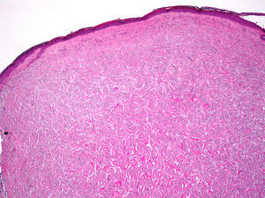 Lesion confined to the dermis with cells arranged in a storiform pattern and hyalinized collagen (case 1) (hematoxylin-eosin, original magnification ×4).