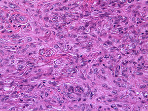 Detail of epithelioid cells showing abundant eosinophilic cytoplasm (case 9) (hematoxylin-eosin, original magnification ×40).