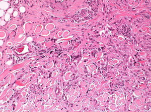 Entrapment of sclerotic collagen bundles by dermatofibroma cells (case 18) (hematoxylin-eosin, original magnification ×20).