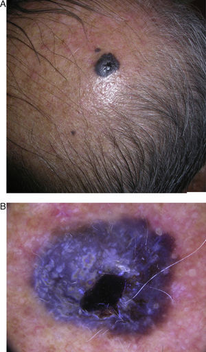 A, Bluish-black nodule in the right parietal region. B, Dermoscopic image showing a homogeneous blue pattern, irregular whitish structures, ulceration, and several large vessels.
