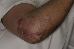 Firm contiguous plaques with crusted areas on a erythematous base and a larger area with a scar-like appearance.
